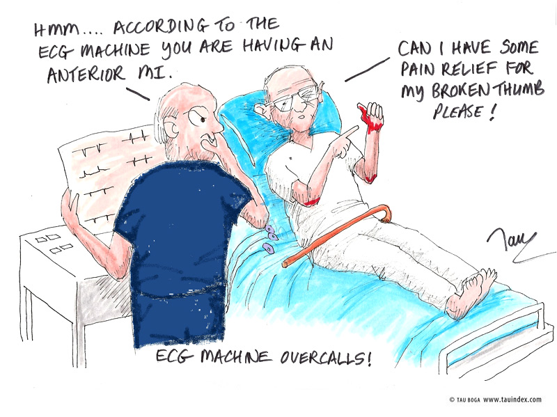 5-ECG-overcalls-Tau-Boga